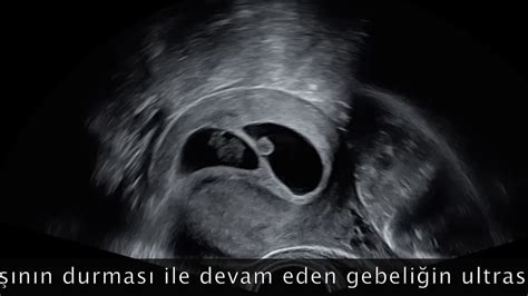 ikiz gebelik ultrason